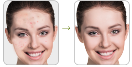 Effect on Acne